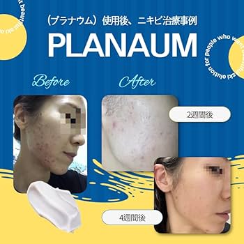 プラビュー　プラズマ美顔器　アトピーにも　プラズマ治療　ニキビ肌治療 プラビュー プラズマ美顔器 アトピーにも プラズマ治療 ニキビ肌治療